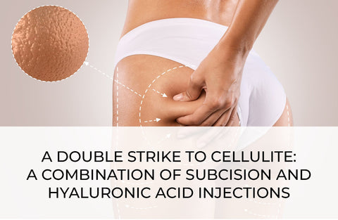 A DOUBLE STRIKE TO CELLULITE: A COMBINATION OF SUBCISION AND HYALURONIC ACID INJECTIONS